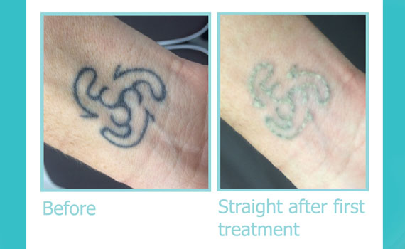 laser tattoo removal in jaipur Archives  Radiant Skin Clinic Laser Hair  Removal  Dermatologist in Jaipur