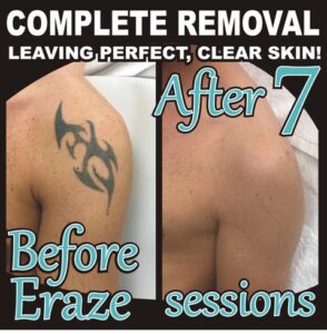laser tattoo removal by eraze