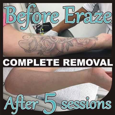 Q-Switched Laser Tattoo Removal | Astanza Trinity Laser