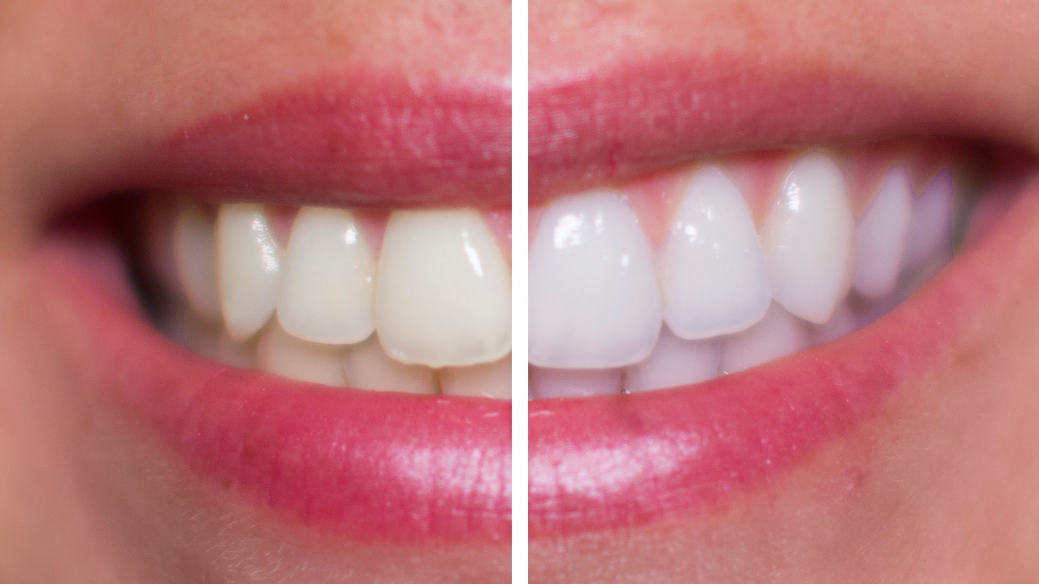 Отбеливание зубов иркутск. Отбеливание зубов. Отбеливание зубов до и после. Покрытие зубов фторлаком. Покрытие зубов белой эмалью для отбеливания зубов.
