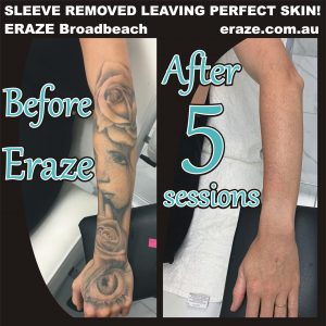 Laser Tattoo Removal - London Real Skin